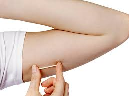 imagem de implante contraceptivo implanon