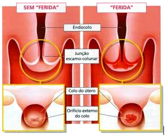 ectopia do colo do útero: imagem com ferida e sem ferida